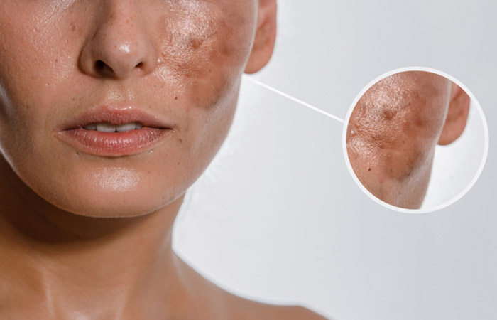 Laser treatment can cause hyperpigmentation