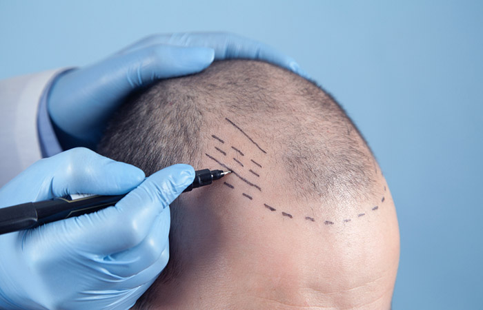 Man getting a hair transplant to tackle frontal hair loss