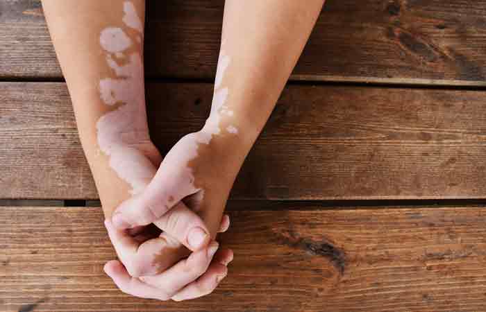 Close up of clasped vitiligo hands