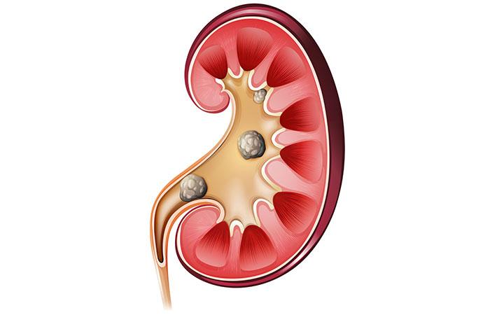 What Are Kidney Stones