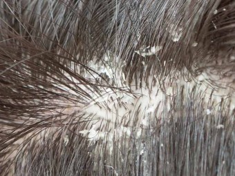 38 Simple Tips To Get Rid Of Dandruff Permanently