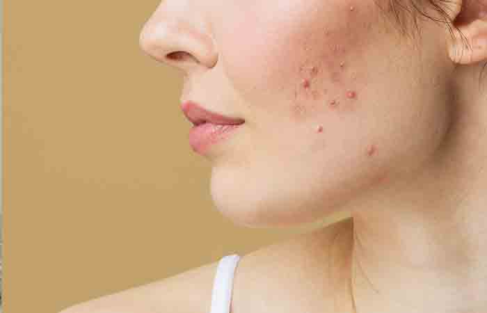 Woman with acne breakouts on face