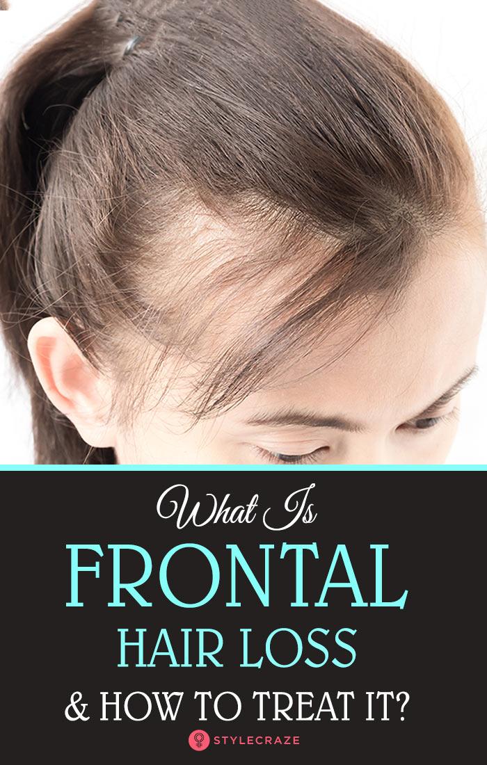 What Is Frontal Hair Loss And How To Treat It