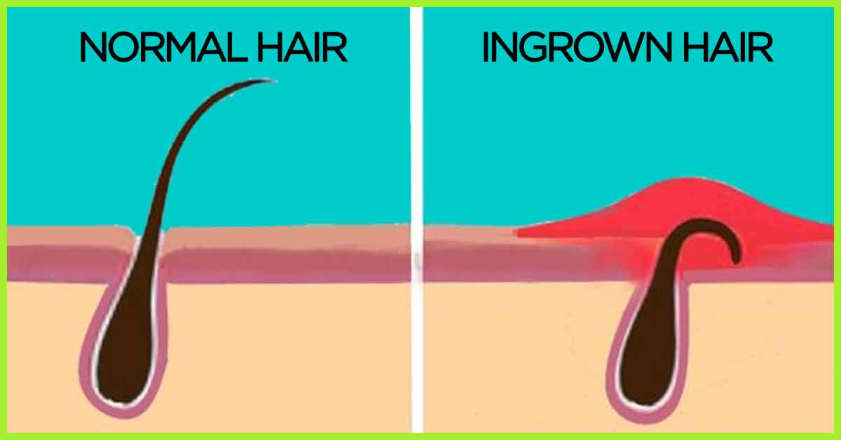 How To Get Rid Of Ingrown Hair Face Bikini Area Legs Arms