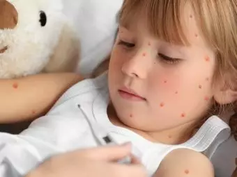 Top 16 Effective Home Remedies To Get Rid Of Chickenpox