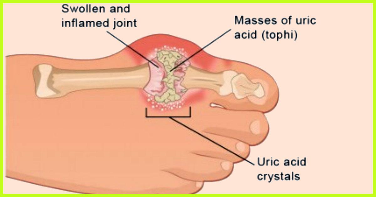 Low Uric Acid Diet Chart