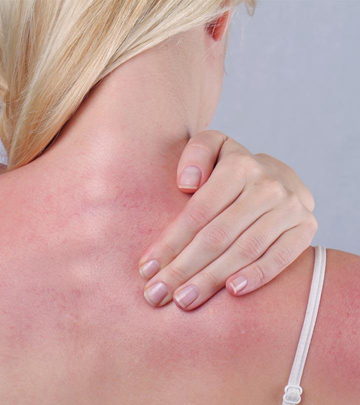 how-to-get-rid-of-sunburn-blisters