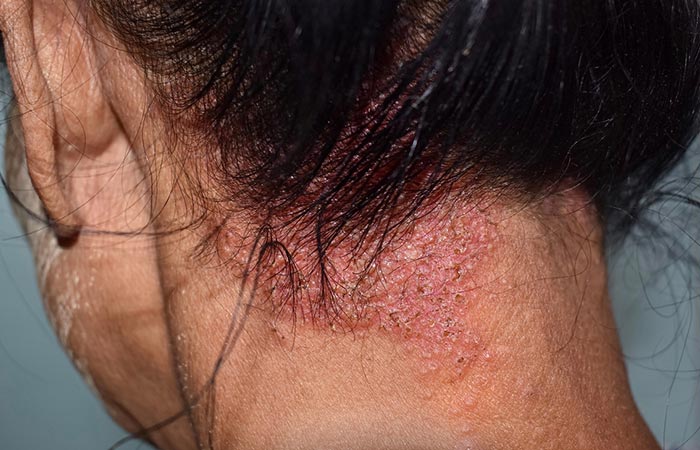 Ringworm scalp  Symptoms  causes  Mayo Clinic