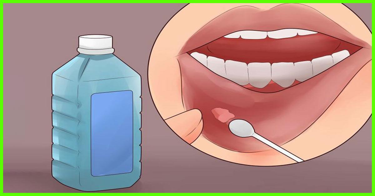 How to Get Rid of Canker Sores — 13 Natural Ways ile ilgili görsel sonucu