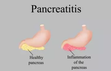 Diagrammatic difference between healthy pancreas and inflammed pancreas