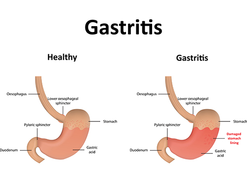 Antral Gastritis Diet Chart