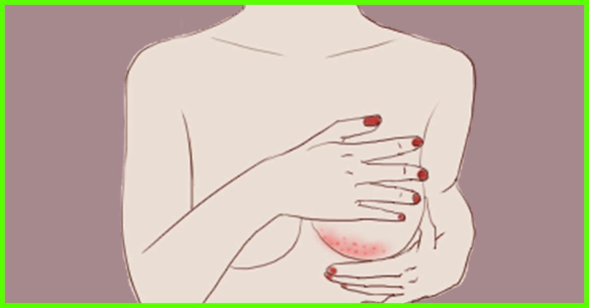 Dark rash under breasts