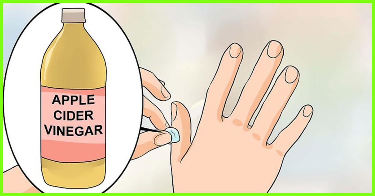 12 Home Remedies For Warts