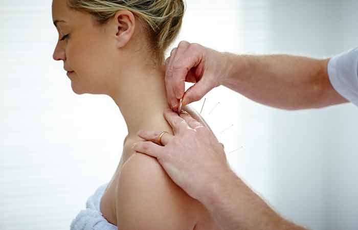 Acupuncture as home remedy for vertigo