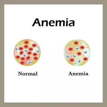 Healthy red blood cell vs red blood cell during anemia