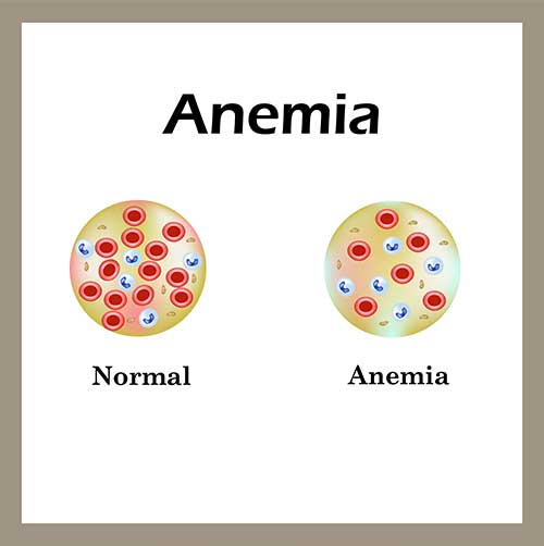 Healthy red blood cell vs red blood cell during anemia