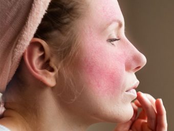 10 Home Remedies For Rosacea That Prevent Redness On The Skin
