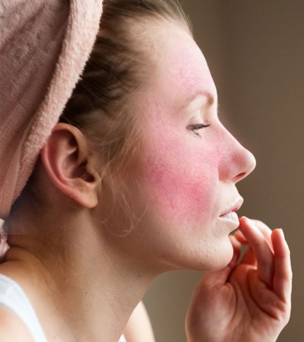 12 Natural Remedies To Manage Rosacea Types Symptoms And Causes