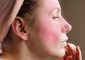 10 Home Remedies For Rosacea That Prevent Redness On The Skin