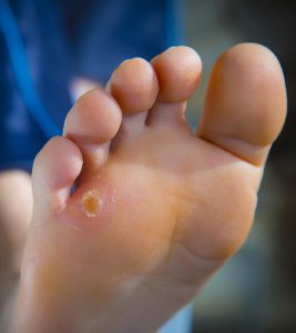 19 Effective Home Remedies For Corns And Calluses