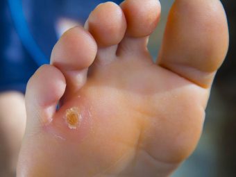 19 Effective Home Remedies For Corns And Calluses