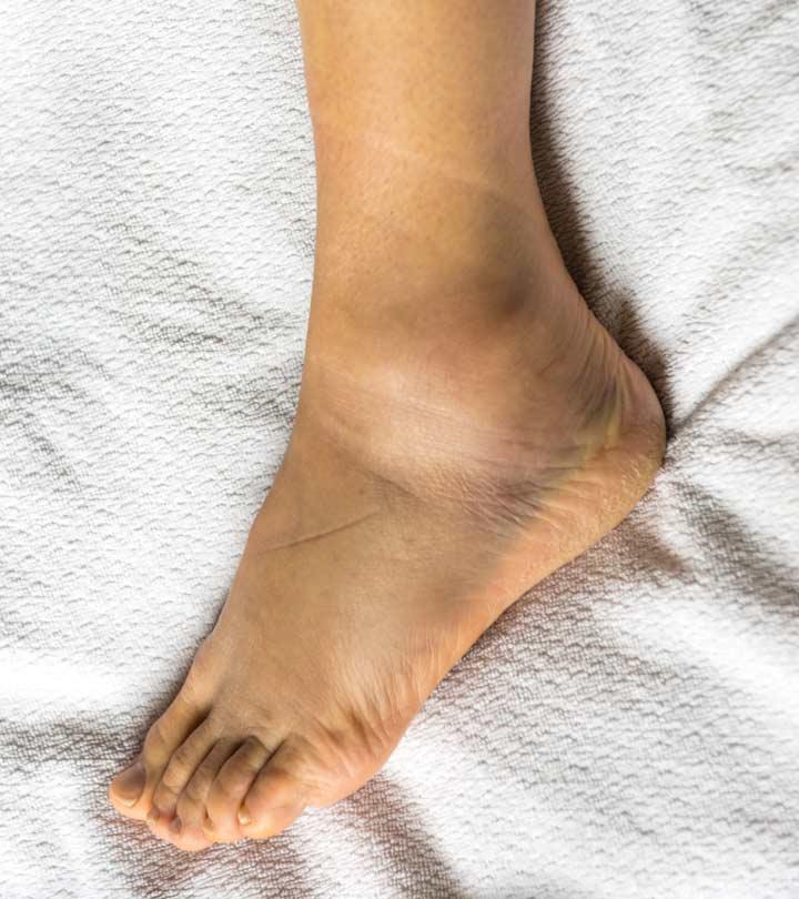 swollen heel treatment