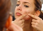 Comedonal Acne: Causes, How To Treat It, & Ways To Prevent It