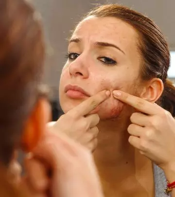 Comedonal Acne - What Is It And 5 Ways To Control It
