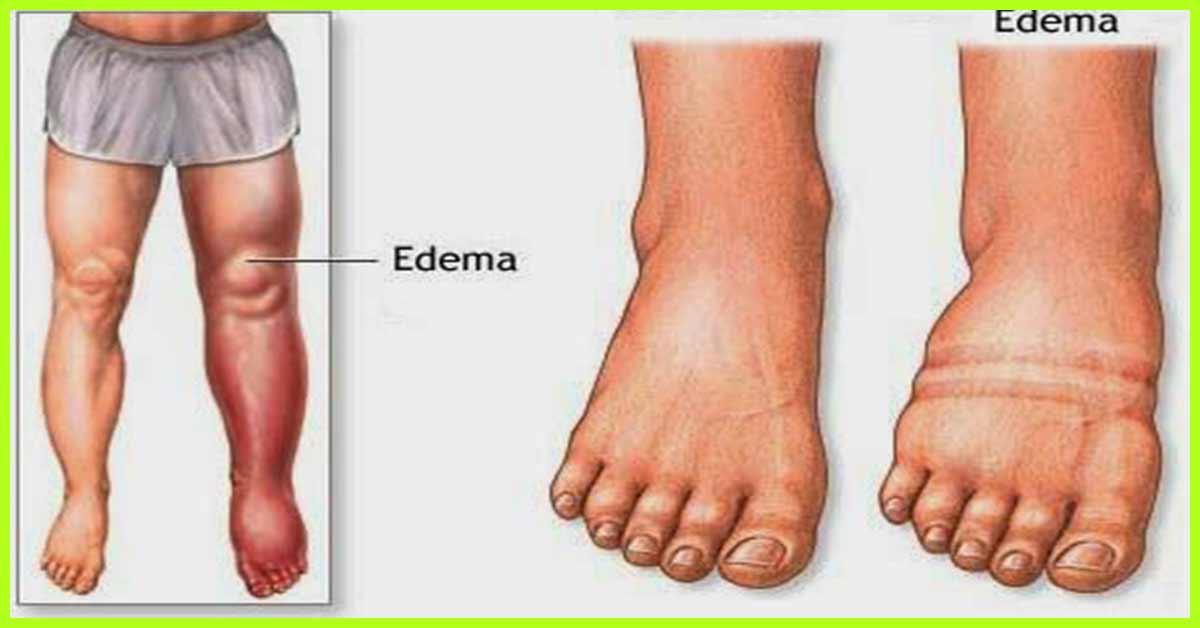 25-remedies-to-treat-edema-naturally-signs-causes-types