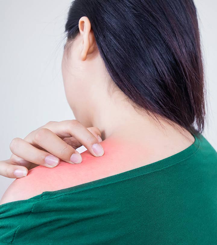 27 Home Remedies For Prickly Heat That Provide Quick Relief