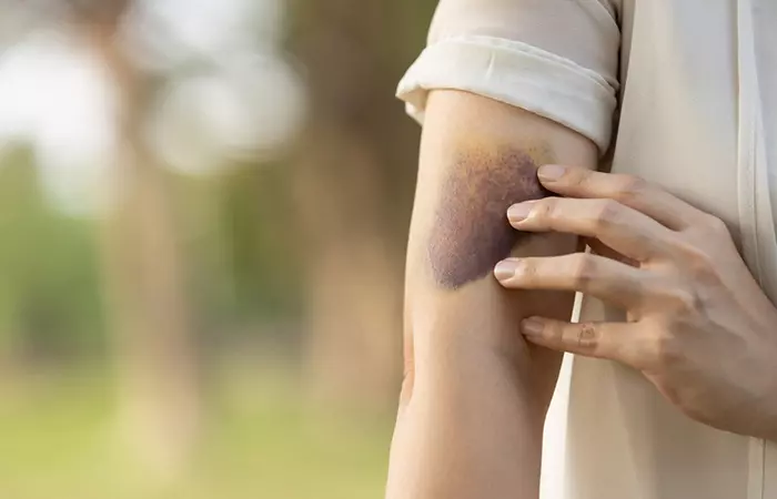 Arnica may reduce bruises.