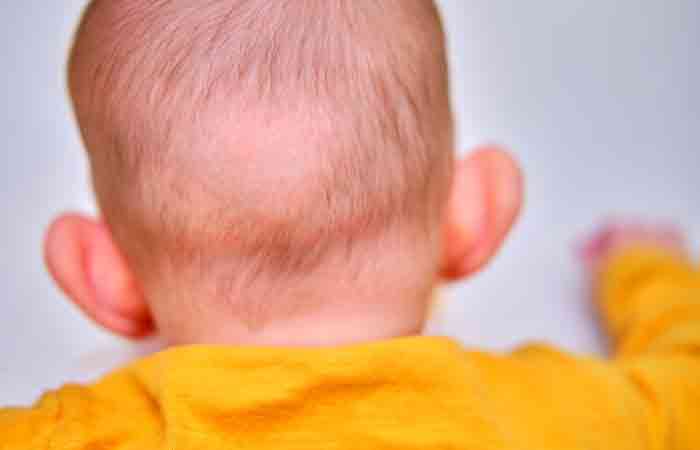 Newborn baby with a bald spot and hair loss 
