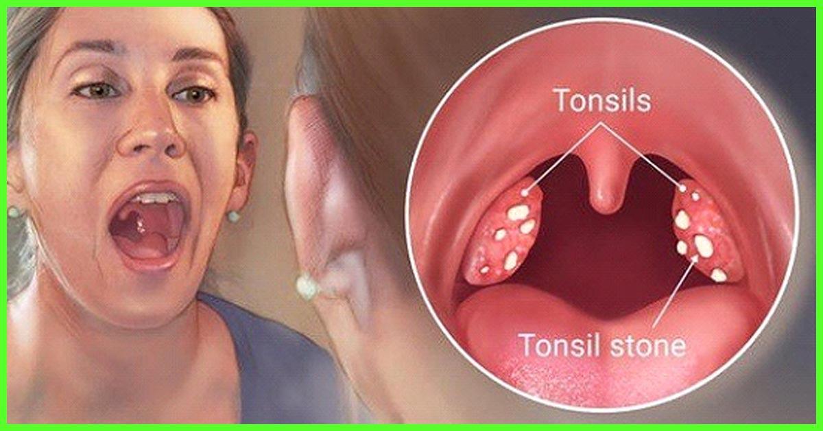 How To Recover From Tonsillitis