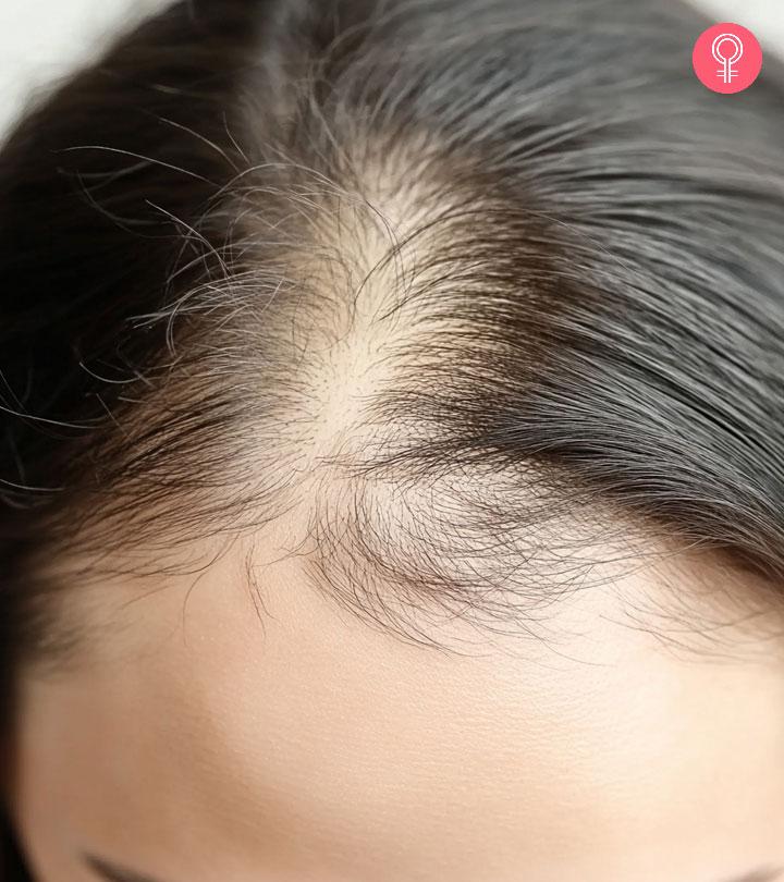 Women WIth Bald Patch