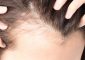 10 Home Remedies To Regrow Hair On Ba...