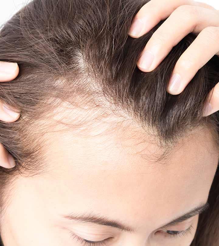 Patch of Hair Loss on the Scalp  MDedge Dermatology