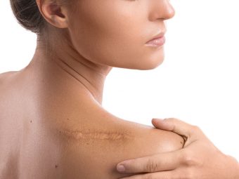 How To Get Rid Of Old Scars – Types, Natural Treatment Options, And Prevention Tips