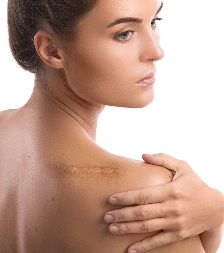 11 Best Ways To Get Rid Of Old Scars, Treatment, & Prevention
