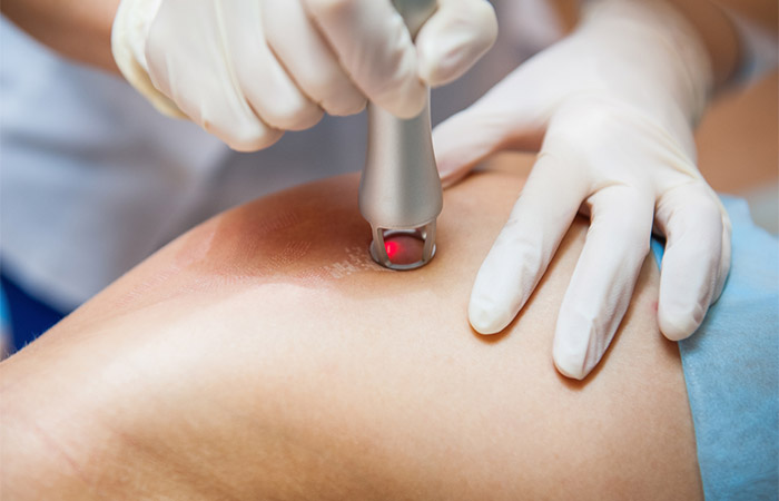 Laser treatment as a medical way to get rid of old scars