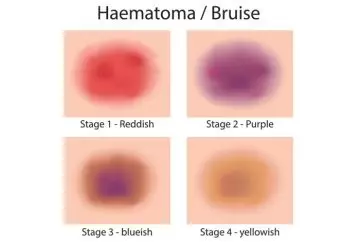 Stages Of Bruising
