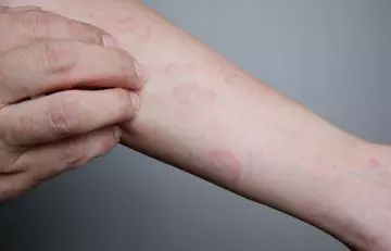 Hives is one of the symptoms of mushroom allergy