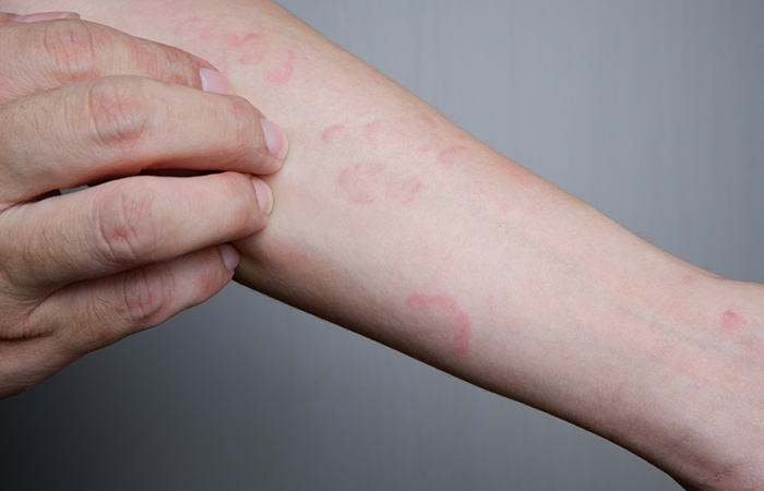 Hives is one of the symptoms of mushroom allergy