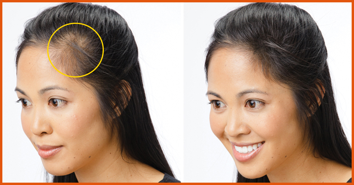 Hairline receding natural for cure Success Story:
