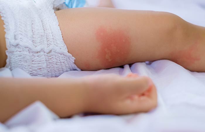 Calendula helps to treat diaper rashes