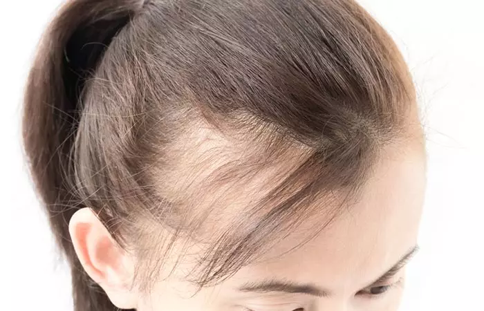 Closeup of a woman's bald patch