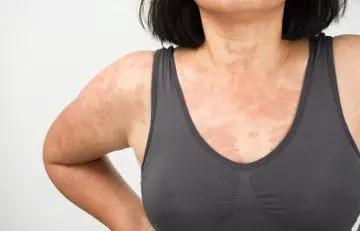 Woman with allergic skin reaction due to St.John's wort