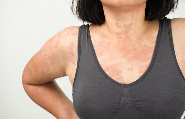 Woman with allergic skin reaction due to St.John's wort