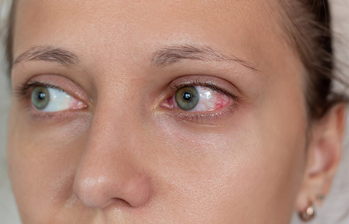 Close up of reddened eyes due to dry eye syndrome