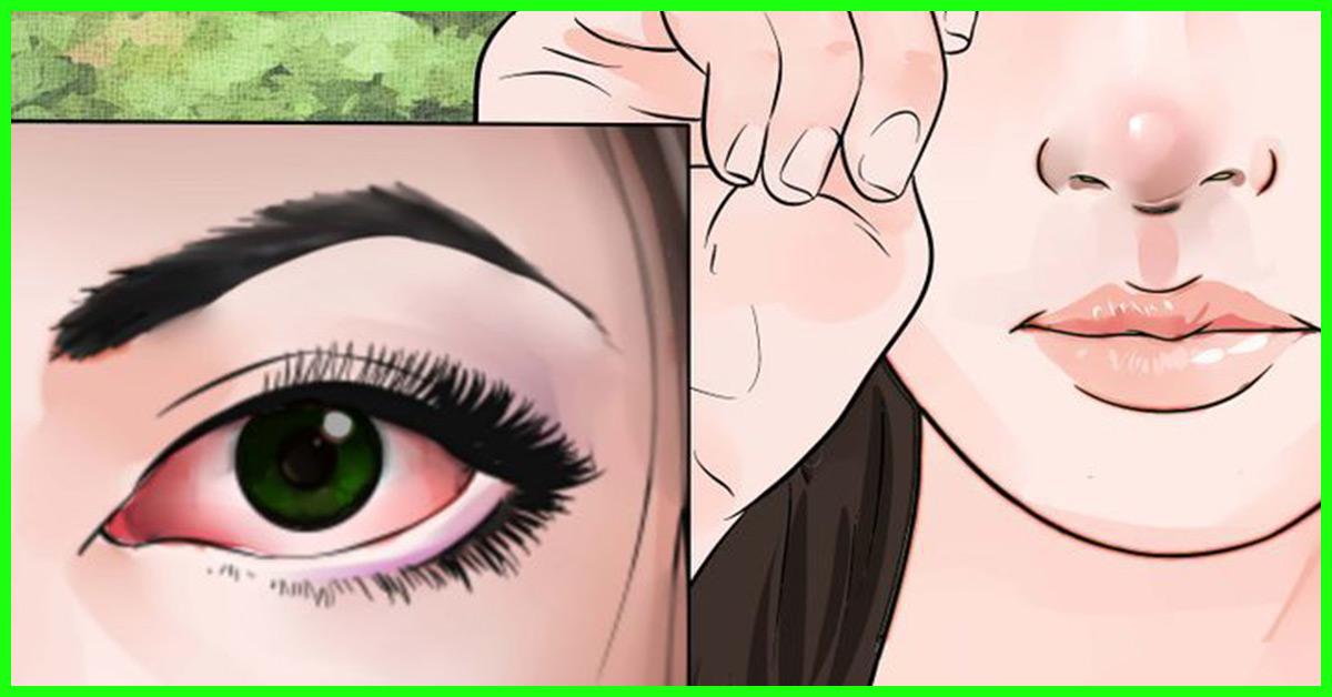 Home Remedies To Treat Sore Eyes 14 Methods Prevention Tips