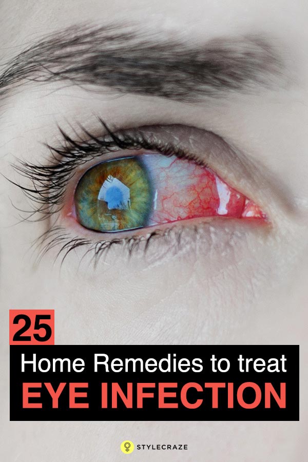 Home Remedies To Treat Sore Eyes 14 Methods Prevention Tips 